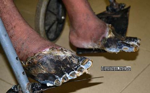 Hai bàn chân người sống bỗng nhiên chết khô ở Lâm Đồng