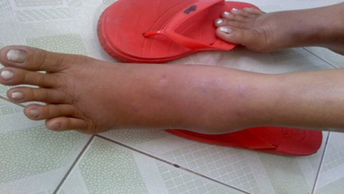 Giun lúc nhúc dưới da vì ăn…lươn, ếch