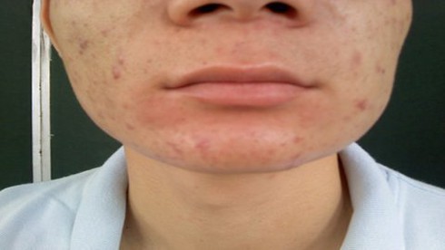 Giun lúc nhúc dưới da vì ăn…lươn, ếch