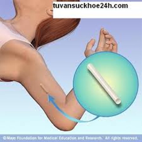 Tránh thai cho vợ chồng son