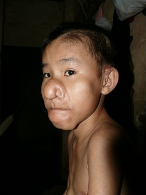 Xót xa cảnh đời cậu bé 'Trư Bát Giới'