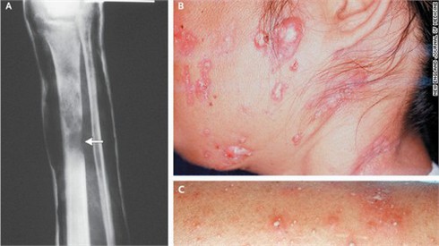 Căn bệnh bí ẩn giống AIDS tấn công người châu Á