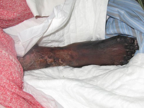 Chết vì tiết canh