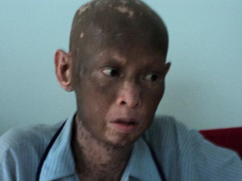 Bệnh lạ khiến một người sụt 40kg, lột da