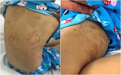 Khởi tố mẹ kế đánh con chồng bầm tím cơ thể - ảnh 1