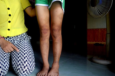 Công an xác minh việc bố đánh con gái 8 tuổi bầm tím hai chân - ảnh 1