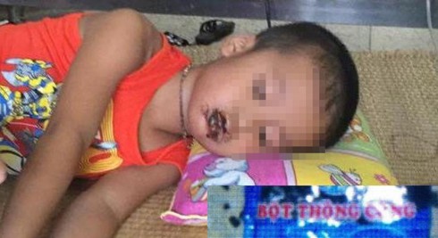 Ăn phải hóa chất tẩy rửa, bốn trẻ mẫu giáo ngộ độc nặng - ảnh 1