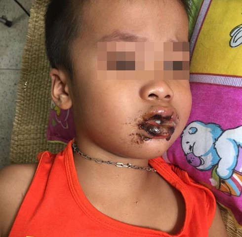 Liên tiếp trẻ uống nhầm hóa chất gây tổn thương nghiêm trọng - ảnh 1