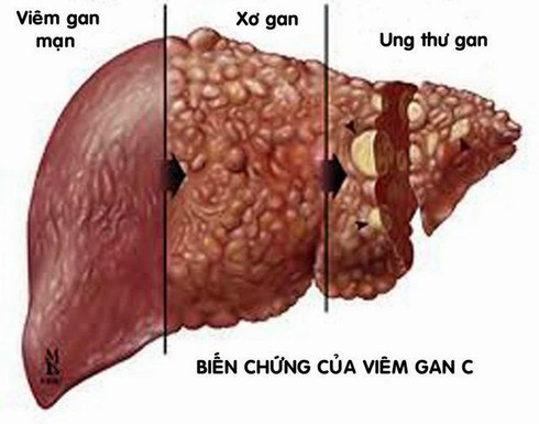 Kinh hoàng căn bệnh khiến 2 tỷ người mắc - ảnh 1