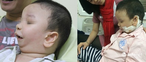 Kỳ tích kéo giãn xương hàm giúp trẻ tụt lưỡi trở lại bình thường - ảnh 1