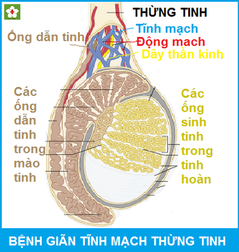 Giãn tĩnh mạch thừng tinh, nguyên nhân gây vô sinh không đáng có - ảnh 1