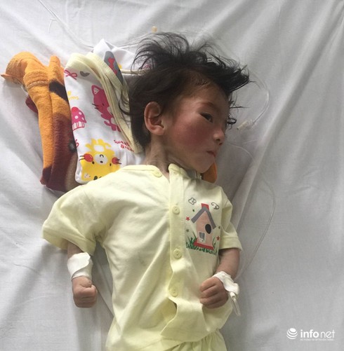 Xót xa bé gái suy dinh dưỡng 14 tháng nặng 3,5 kg - ảnh 1
