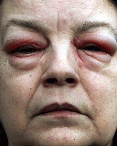 Vì sao thuốc nhỏ mắt có thể gây mù, tử vong? - ảnh 1