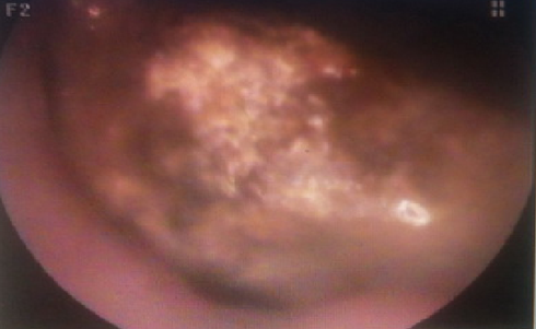 Gắp viên đá dài 15mm nằm trong hốc mũi cụ ông suốt 80 năm - ảnh 1