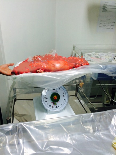 Phẫu thuật lấy khối u 13kg trong bụng bà cụ 100 tuổi - ảnh 1