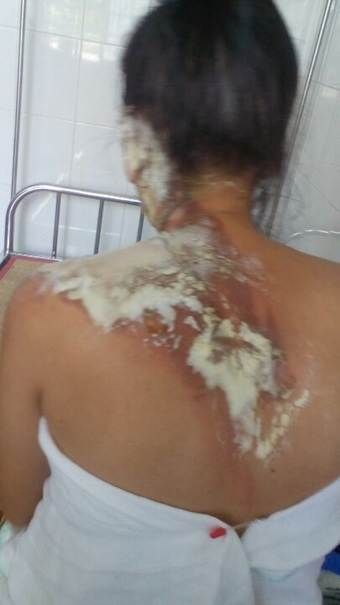 Công an mời người chồng rót nước sôi vào lỗ tai vợ lên làm việc - ảnh 1