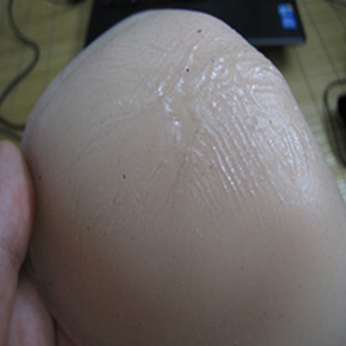 Nhiễm trùng, mưng mủ, tróc da... vì dán ngực 2