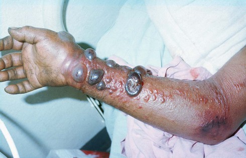 Bệnh nhân Ebola tử vong đáng sợ như thế nào? - ảnh 1