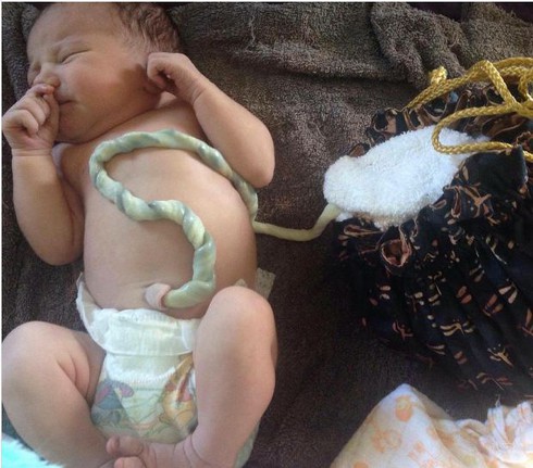 Sinh con không cắt dây rốn: Lợi hay hại? - ảnh 2