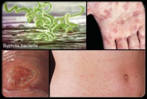 Đầu năm vợ chồng suýt li hôn vì bệnh giang mai - ảnh 2