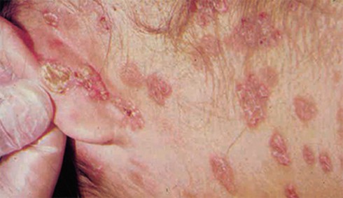 Đầu năm vợ chồng suýt li hôn vì bệnh giang mai - ảnh 1