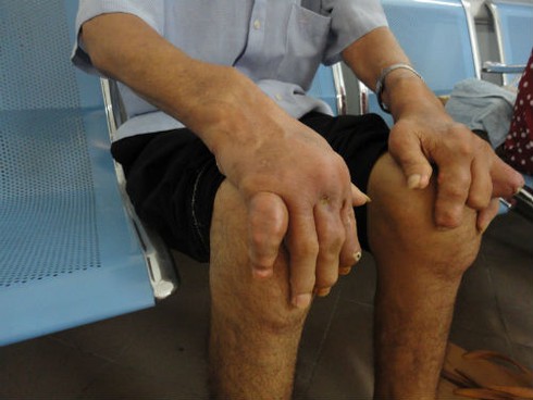 Nỗi thống khổ của bệnh nhân gout ngày Tết - ảnh 2