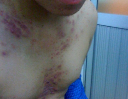 Chưa đến Tết mụn đã mọc đầy người - ảnh 1