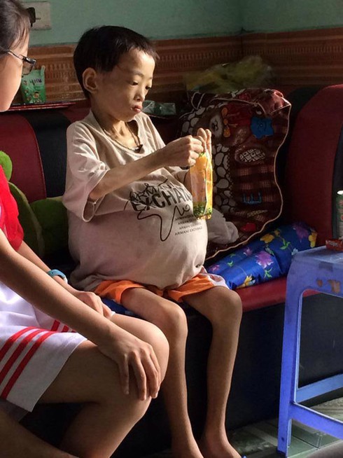 Xót xa cháu bé 10 tuổi, ôm bụng to như cái trống - ảnh 1