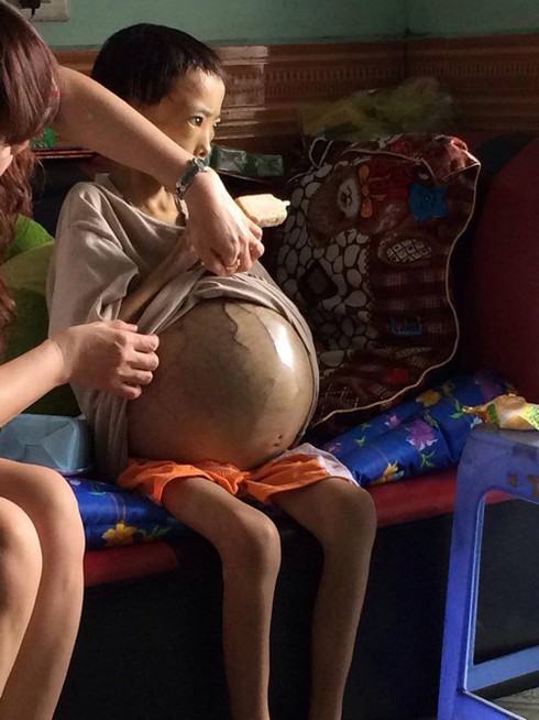 Xót xa cháu bé 10 tuổi, ôm bụng to như cái trống - ảnh 2