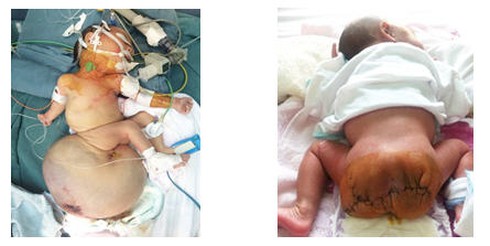 Cắt khối u quái 2,6kg, nặng hơn trọng lượng bệnh nhi 6 ngày tuổi - ảnh 1