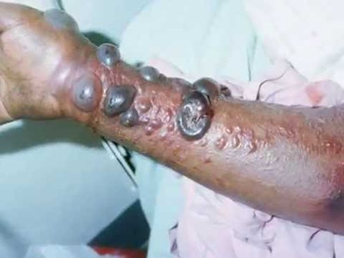 Tin mới nhất về bệnh Ebola ngày 11/8: Gửi mẫu xét nghiệm sang Mỹ - ảnh 1