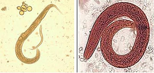 Kinh hãi giun lươn chu du trong cơ thể - ảnh 2
