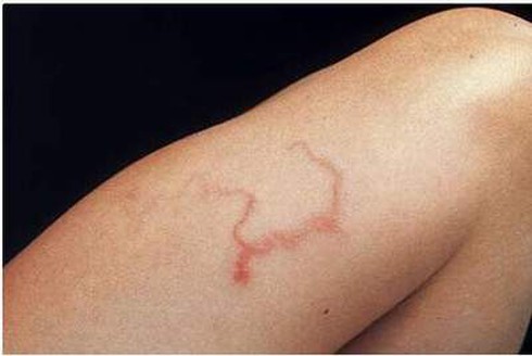 Kinh hãi giun lươn chu du trong cơ thể - ảnh 1