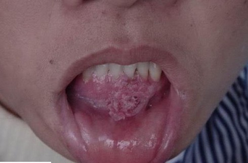 Hôn bạn trai, mắc ngay sùi mào gà quanh miệng - ảnh 1