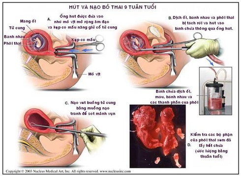 Vô sinh vì phá thai nhiều lần, cầu xin bác sĩ nói dối chồng - ảnh 1