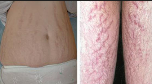 Rạn da bụng sau sinh, chồng buông lời chê bai - ảnh 1