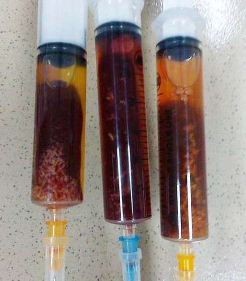 Ăn bò tái, cua nướng, bị sán tấn công gây tràn dịch màng tim - ảnh 1