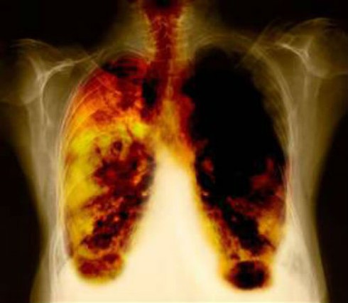 Phổi đen xì: Những hình ảnh này có thể khiến bạn bất ngờ, nhưng chúng ta không thể phủ nhận tác động ác liệt của khói thuốc đến sức khỏe của chúng ta. Khi xem bộ sưu tập phổi đen xì này, bạn sẽ cảm nhận được tầm quan trọng của việc bảo vệ sức khỏe và sống một cuộc sống lành mạnh hơn.