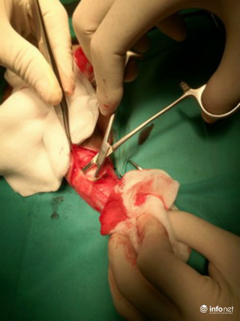 Phẫu thuật cho quý ông bị kiếm cong: Đau chói mới tìm đến bác sĩ - ảnh 1