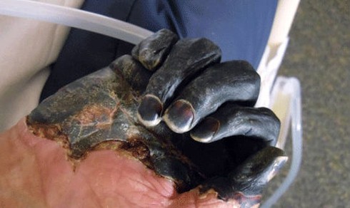 Bác sĩ ám ảnh cảnh bệnh nhân nằm la liệt, tím đen vì dịch hạch - ảnh 1