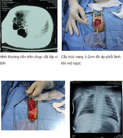Viêm phổi liên tục: Dị dạng nang phổi bẩm sinh - ảnh 1