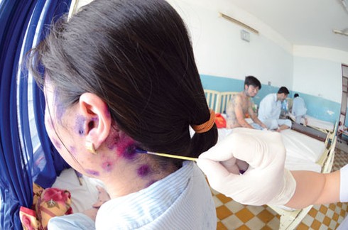 Bà bầu bị thủy đậu sẽ gặp biến chứng nguy hiểm như thế nào? - ảnh 1