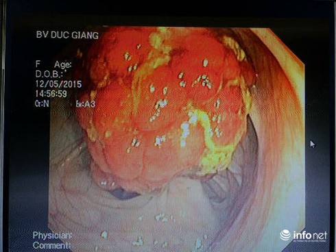 Đau bụng, đi ngoài ra máu: Coi chừng polyp đường tiêu hóa - ảnh 1