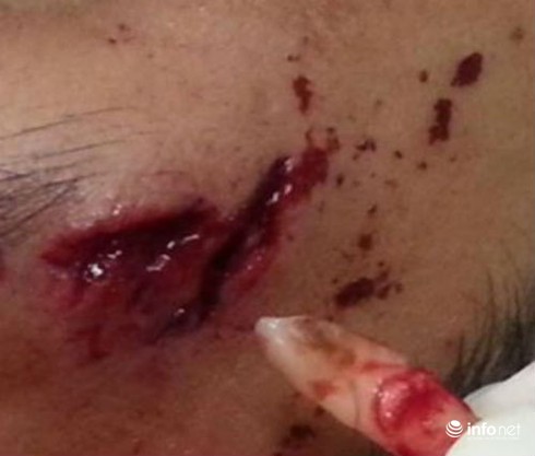 Nam sinh vào cấp cứu với một chiếc răng nanh cắm sâu trong trán - ảnh 1