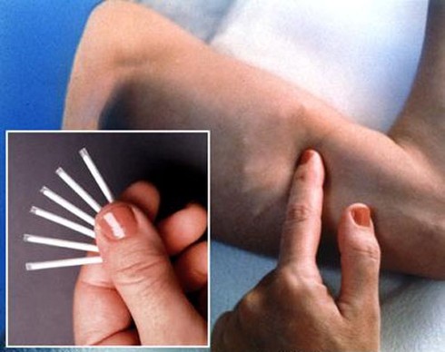 Cấy que tránh thai: Biện pháp mới, ưu việt hơn? - ảnh 1