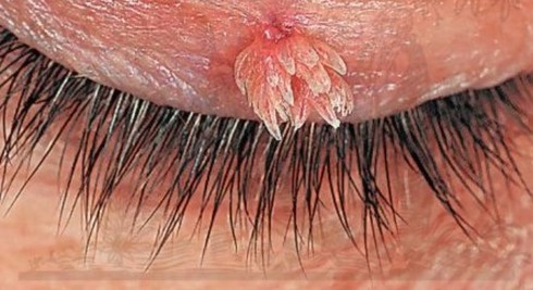 Mắc sùi mào gà vì hay đi hát karaoke