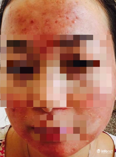 Vì sao thuốc trị mụn gây vô sinh? - ảnh 1