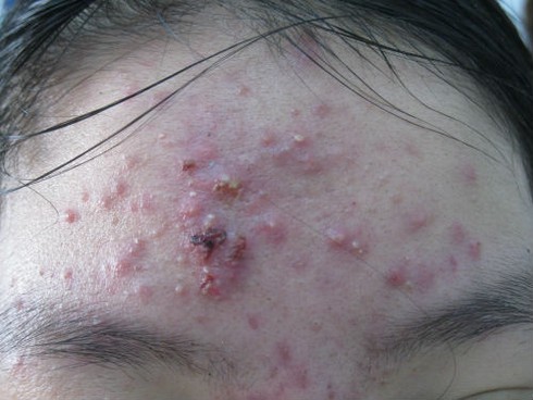 Thuốc trị mụn trứng cá gây dị tật thai nhi,chống chỉ định với thai phụ - ảnh 1