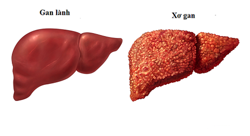 Hình ảnh gan biến dạng vì rượu, bác sĩ giật mình