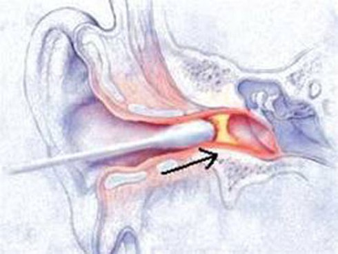 Thủng màng nhĩ vì chăm chỉ lấy ráy tai cho con - ảnh 1